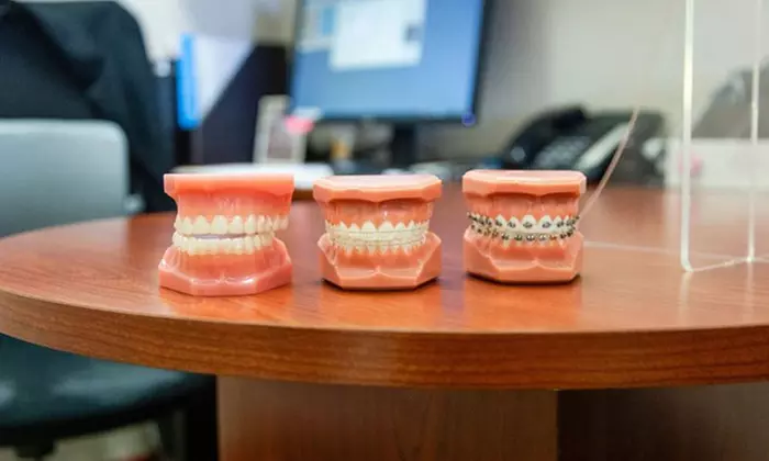 Stunning Smile with Clear Aligners, Clear/Metal Braces