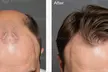 Transform Your Hair w/ 1 or 2 Sessions of Laser Hair Restoration + Consultation at Natural Touch (Up to 50%Off) - Second Medium