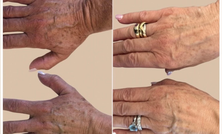 Image 4: Revitalize with Full Face ADVATx Laser Facials