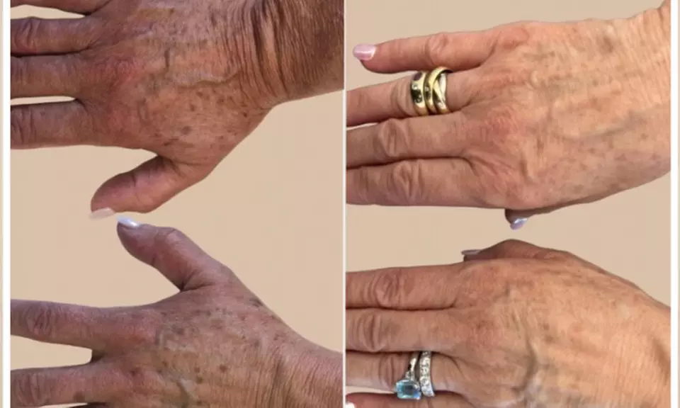 AdvaTx Laser Knightsbridge - Skin Rejuvenation For Pigmentation & More