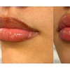Image 2: Up to 37% Off on Injection - Dermal Filler at Holistic Health and Medical