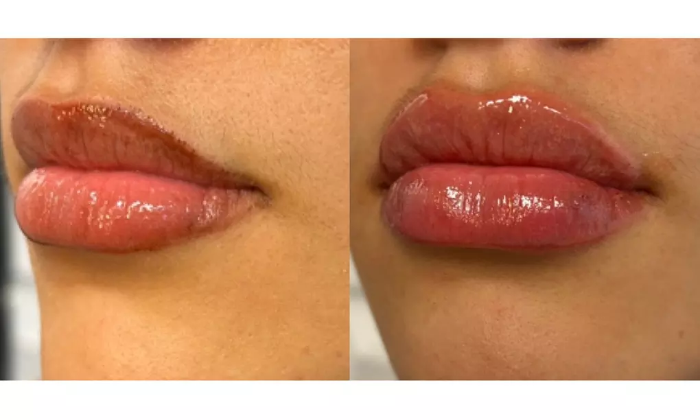 Enhance Your Lips with Half or Full Syringe Fillers