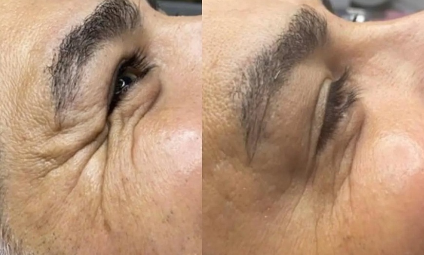 Image 6: Up to 50% Off on Injection - Filler and Freezer at Eleganza Aesthetics