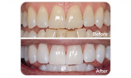 One In-Office Zoom Teeth Whitening Session - Luxe Dental Birmingham