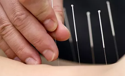 $30 for an Acupuncture Session at St. Louis Acupuncture Clinic in Chesterfield ($75 Value) - Primary Image