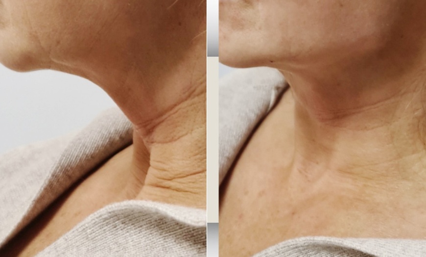 Image 4: RF Microneedling Treatment W/ Skin Nourishing Serum / Skin-Boosting 