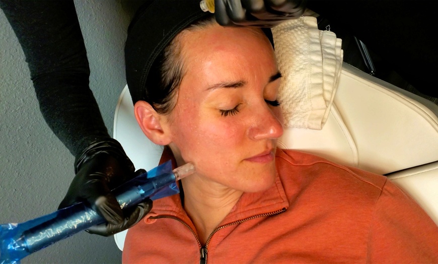 Image 3: Bio Filler Injections and PRP Facials for Natural-Looking Skin 