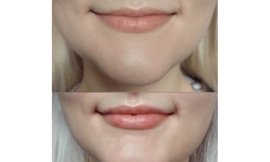 Image 2: Revitalize with 60 Units of Dysport or Lip Flip Dysport Injections