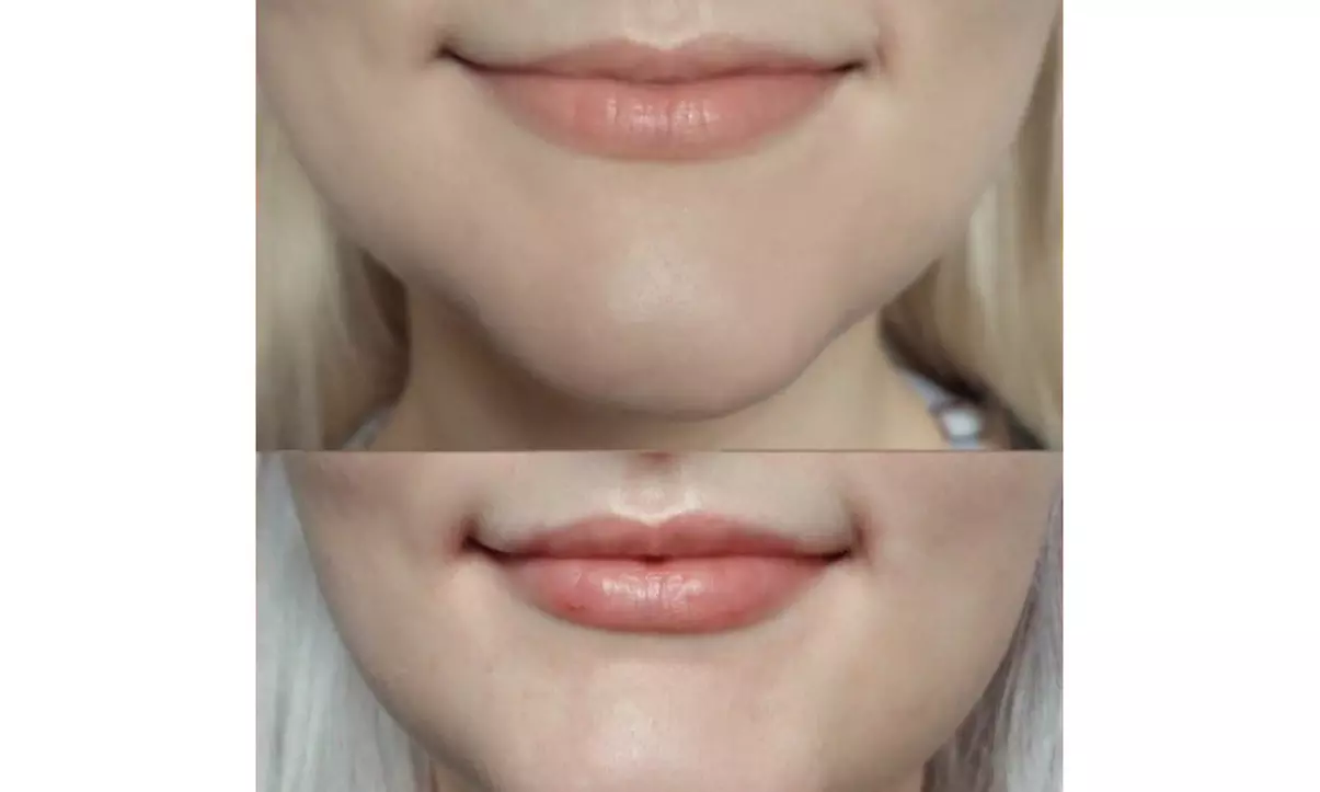 Revitalize with 60 Units of Dysport or Lip Flip Dysport Injections