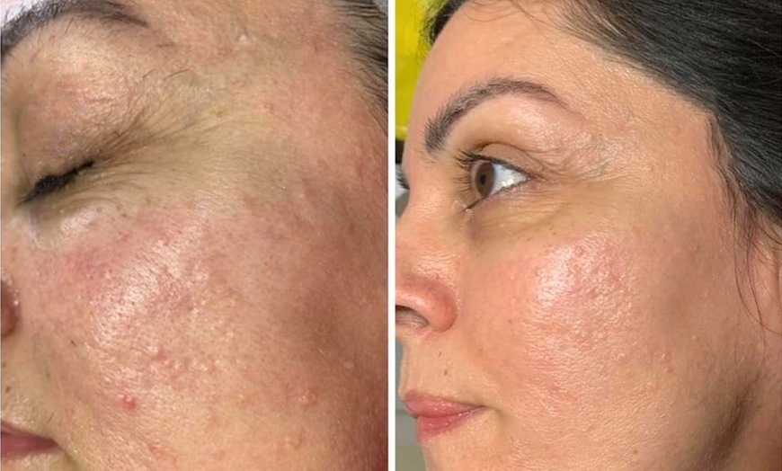 Image 4: Up to 57% Off on Facial - Fruit Acid Peel at SKIN IQ Aesthetics & Wellness