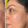 Image 4: Up to 57% Off on Facial - Fruit Acid Peel at SKIN IQ Aesthetics & Wellness