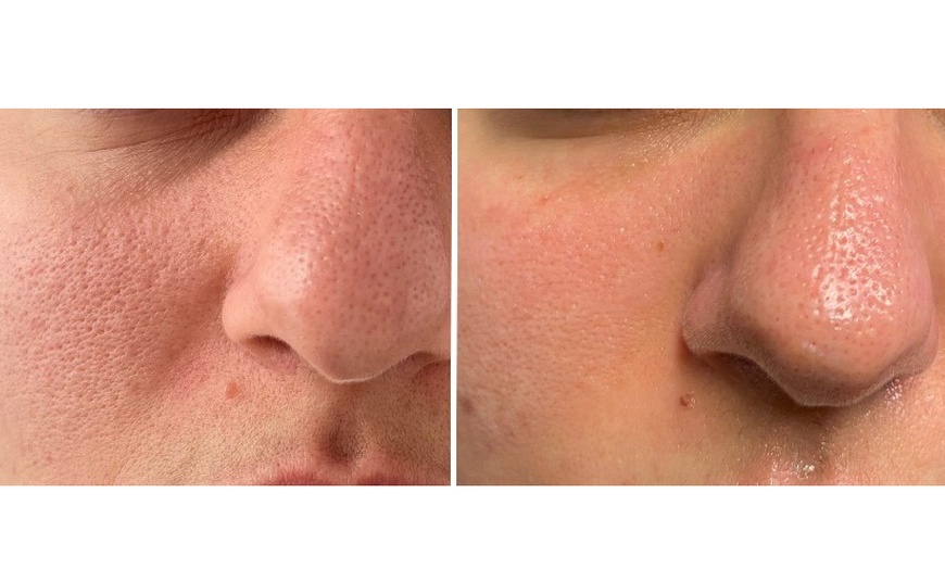 Image 3: Microneedling-Behandlung oder Enzym-Lifting-Paket für 1 Person