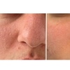 Image 3: Microneedling-Behandlung oder Enzym-Lifting-Paket für 1 Person