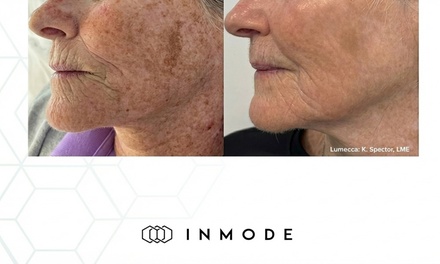 One IPL-Photo Rejuvenation Treatments for the Face - Attune Dentistry