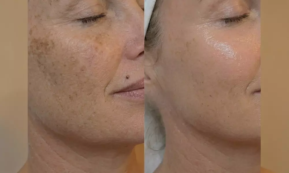 Unifiez votre teint avec un soin anti-taches ciblé 5G Removal