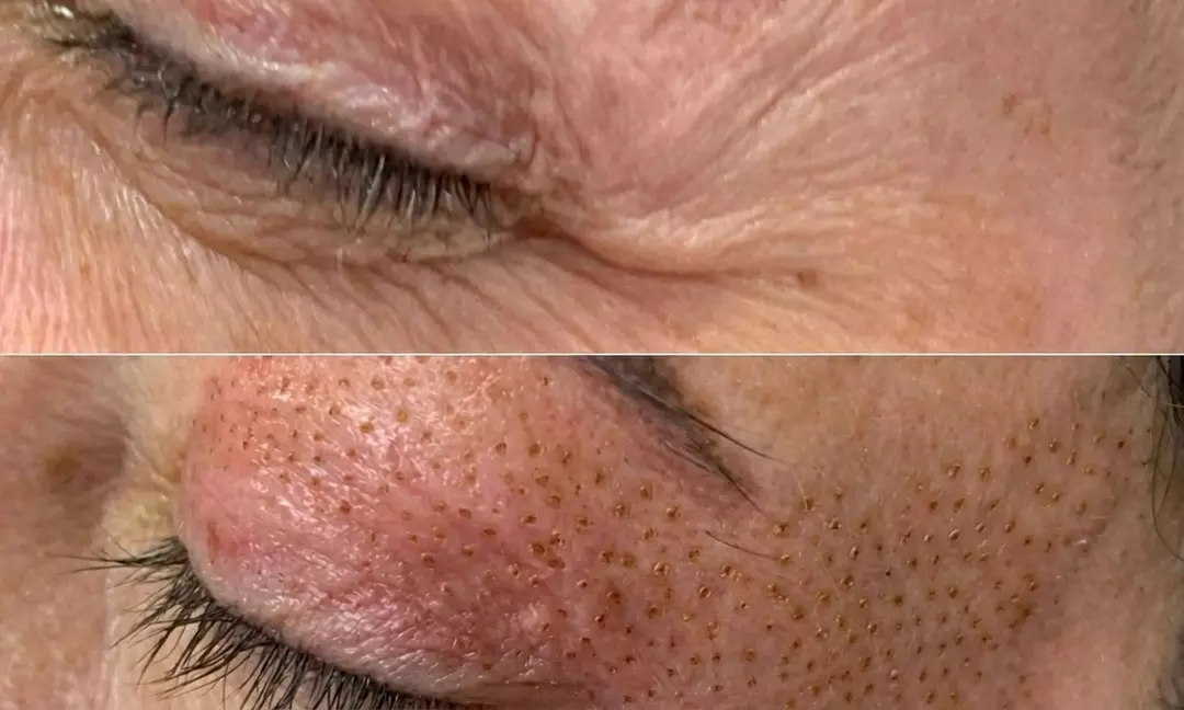 1 o 2 sesiones de plasma pen en zona a elegir para 1 persona