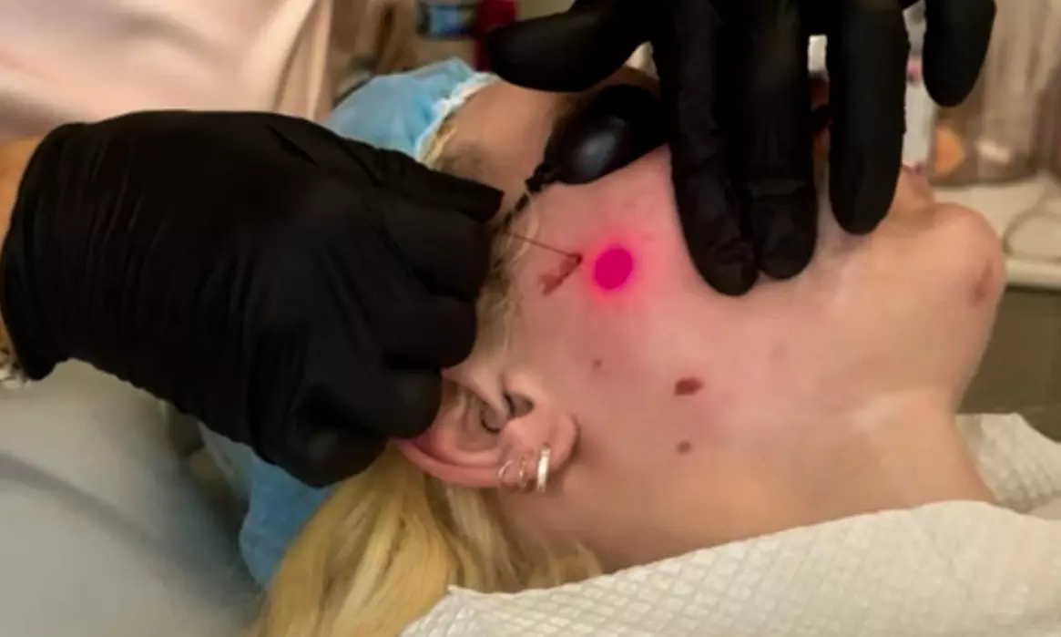 One or Two Hours EndoLift Non-Surgical Facelift on One or Two Areas