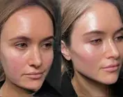 Revitalize w/ 1, 3 or 6 Radio Frequency Skin-Tightening Treatment 