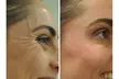 Get a Revitalized Look with 20, 30, or 40 Units of Xeomin Tailored to Your Needs (Up to 22% Off) - Second Medium