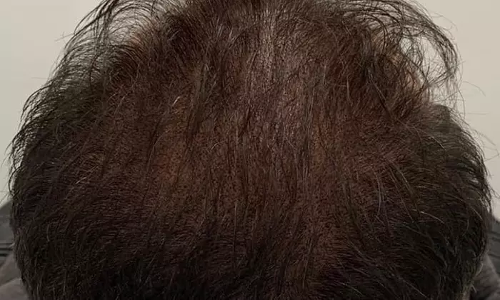 Scalp Micropigmentation