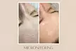 Frische Haut: 1 oder 2x 60 Min. kosmetisches Microneedling inkl. LED-Therapie für 1 Person (bis 59% sparen) - Image 5