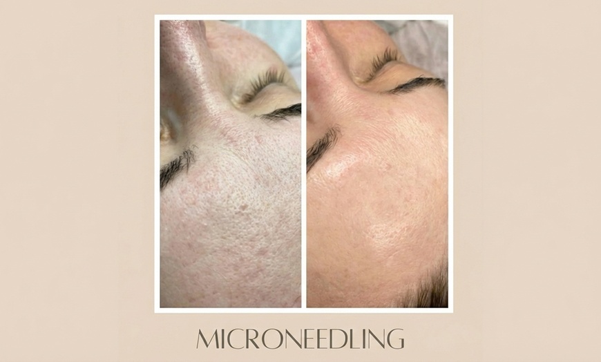 Image 5: 1 oder 2x 60 Min. kosmetisches Microneedling inkl. LED-Therapie