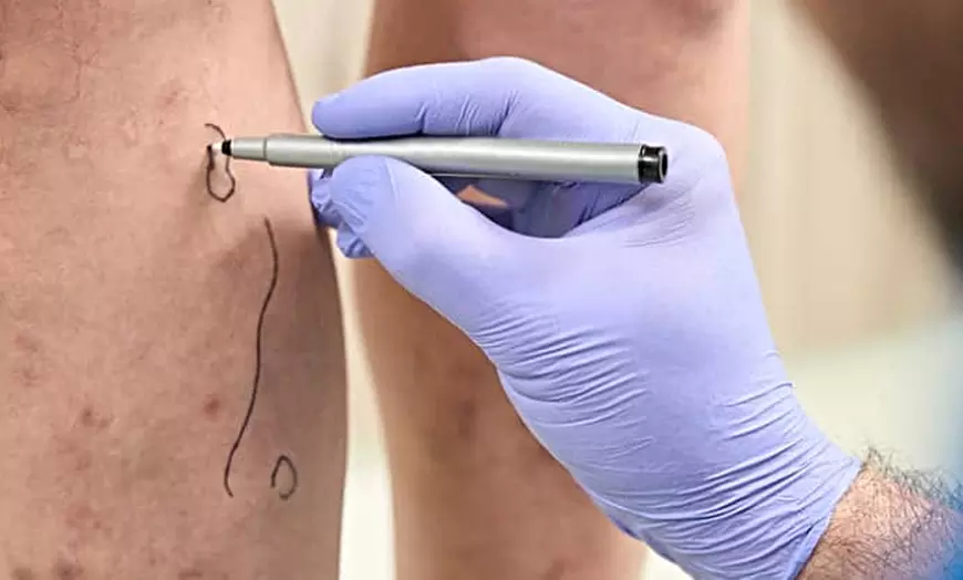 Image 13: Eliminación de varices o verrugas con tecnología avanzada 