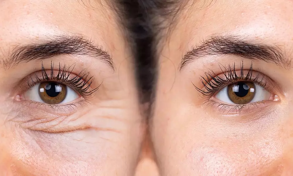  Revitalize Your Look with 20, 40, or 60 Units of Botox
