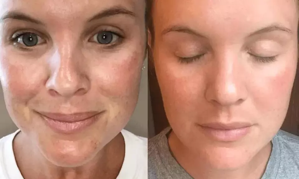 One Clinical PRP Treatment with Biotin and Exosomes