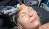 Enhance Your Skin with One, Two or Three Microneedling Treatment with PRP Facial at Dba IBeyond (Up to 60%Off)