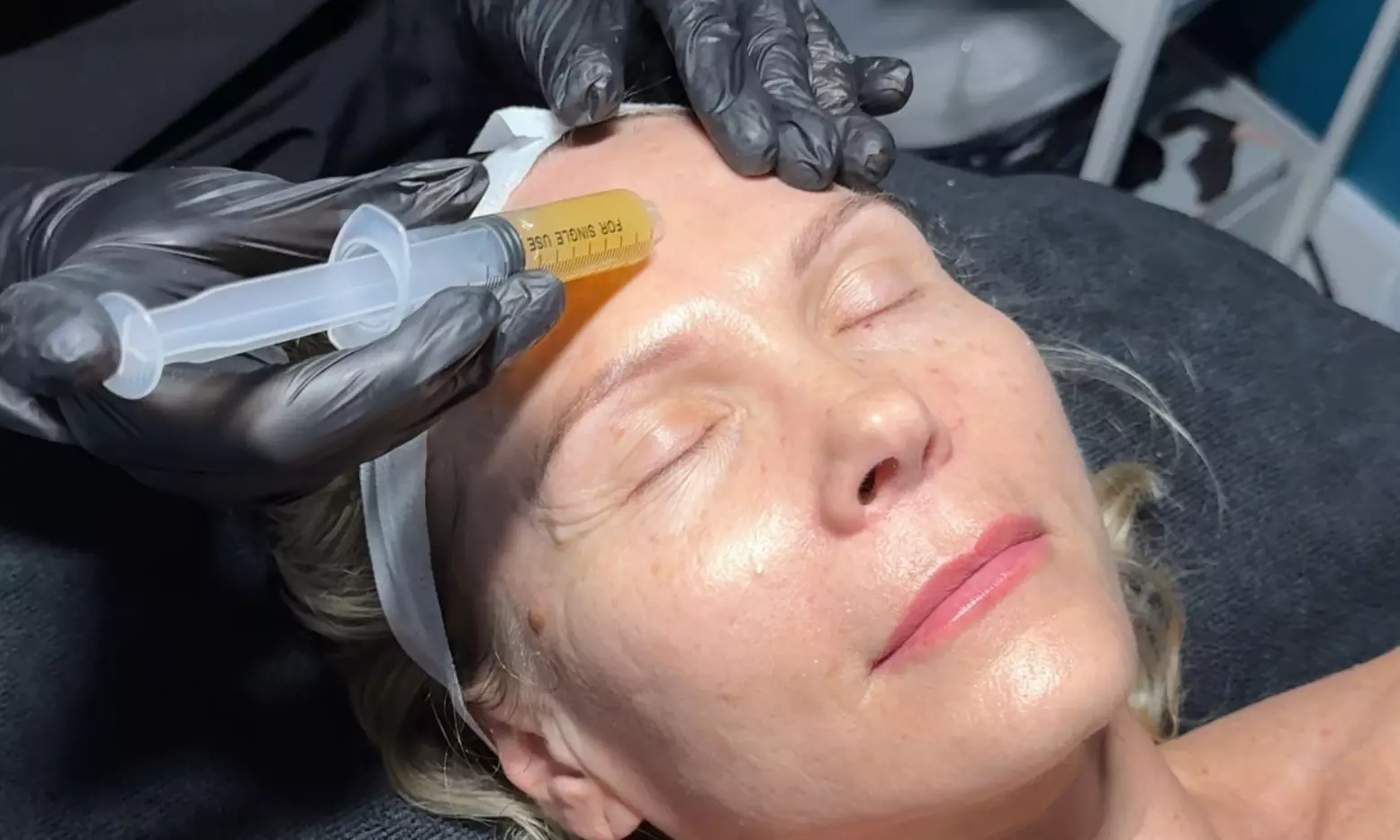 Glow with One, Two or Three Microneedling Treatment with PRP Facial