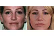 Revitalize Your Under Eyes with One session EZ GEL PRF for Under Eyes (Up to 30% Off) - Second Medium