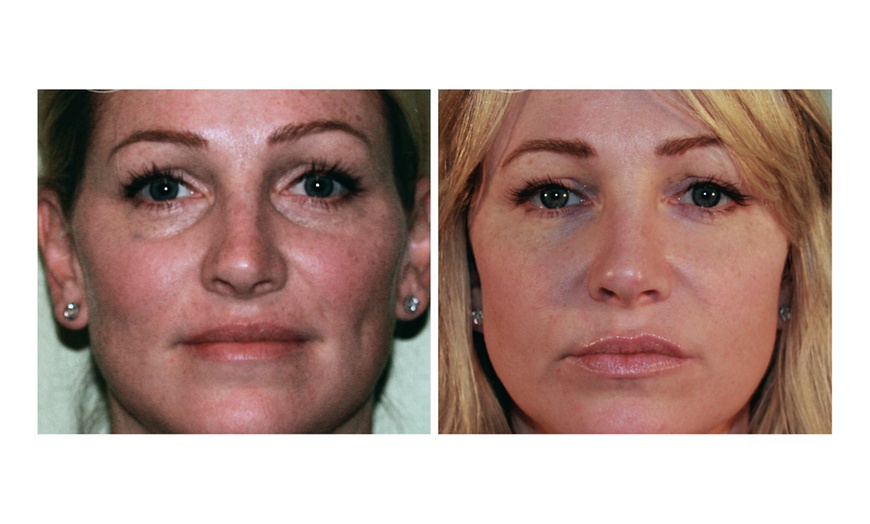 Image 2: Experience Youthful Eyes with One session EZ GEL PRF for Under Eyes