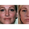 Image 2: Experience Youthful Eyes with One session EZ GEL PRF for Under Eyes