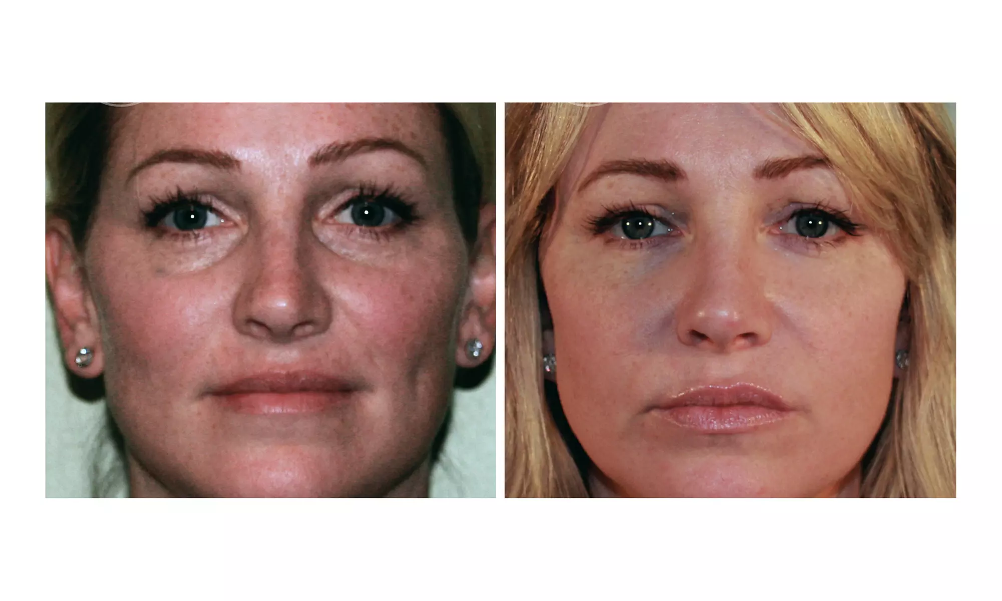 Experience Youthful Eyes with One session EZ GEL PRF for Under Eyes