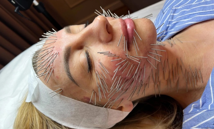 Image 2: Needle Shaping: lifting bez skalpela na twarz, szyję i dekolt 