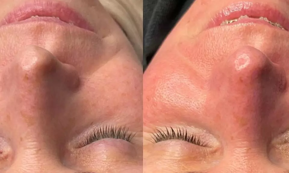 One, Three, or Five Sessions of Advanced HydraFacial or DermaPlaning