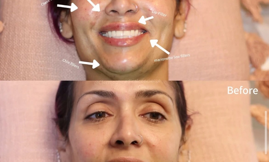 Image 2: Add Volume and Facelift with a Choice of Syringes of Radiesse Filler
