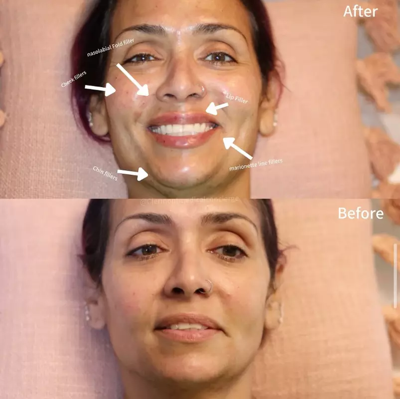 Add Volume and Facelift with a Choice of Syringes of Radiesse Filler