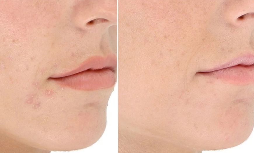 Image 4: LightStim Red Light Therapy Packages | Full Body Treatment
