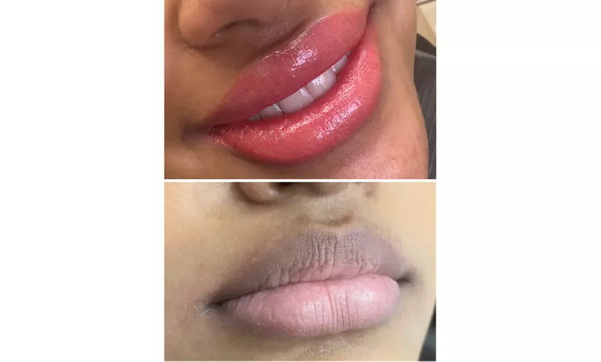 Image 14: CO2 Skin Rejuvenation for Face, Neck, & Eyes