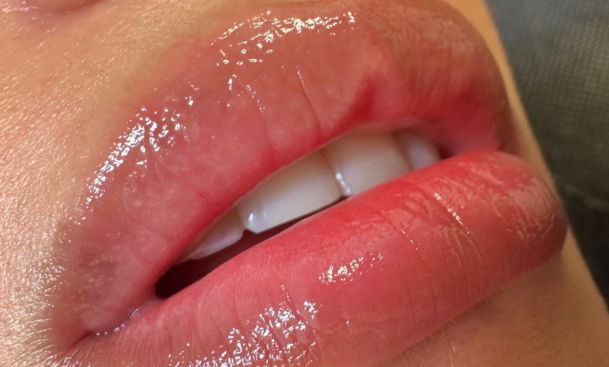 Image 2: Sesión de rehidratación de labios con dermapen y vitaminas para 1 