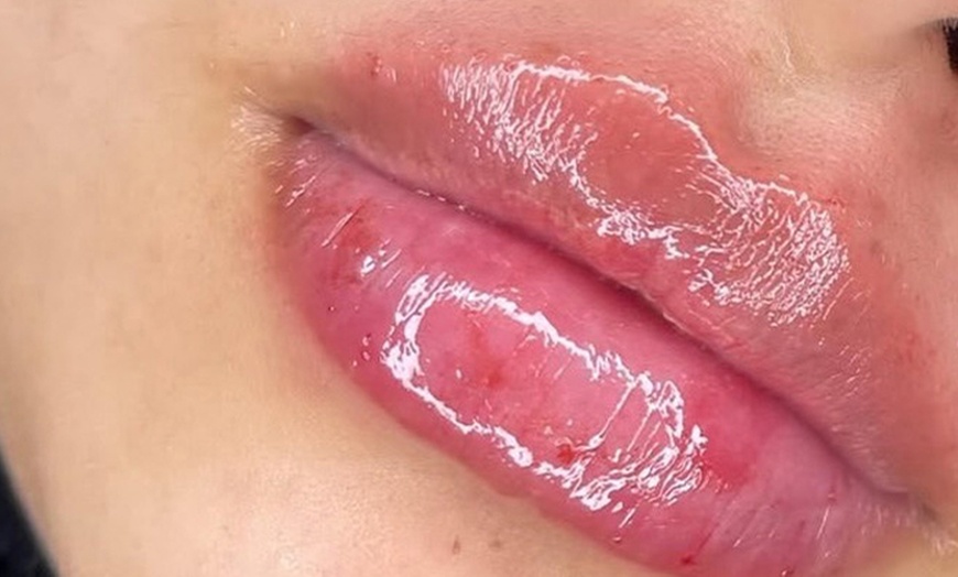 Image 3: Enhance w/ 0.5, 1, 2ml Lip Filler or  0.5ml Lip Filler + Smile Lines