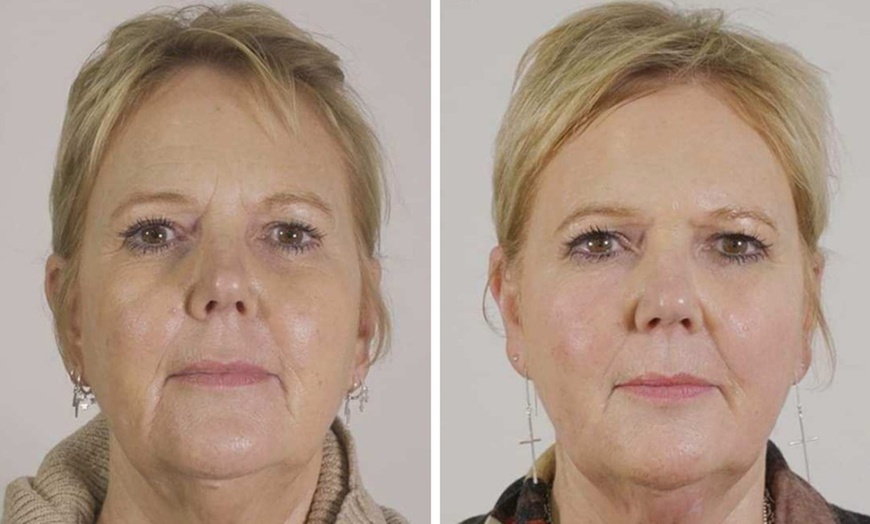 Image 2: Glowing Skin with One or Two Seventy Hyal Treatment & Consultation 