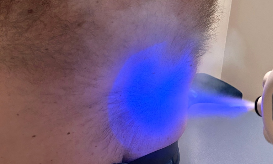 Image 4: Targeted Cryotherapy Relief: Opt for Single or Multiple Sessions
