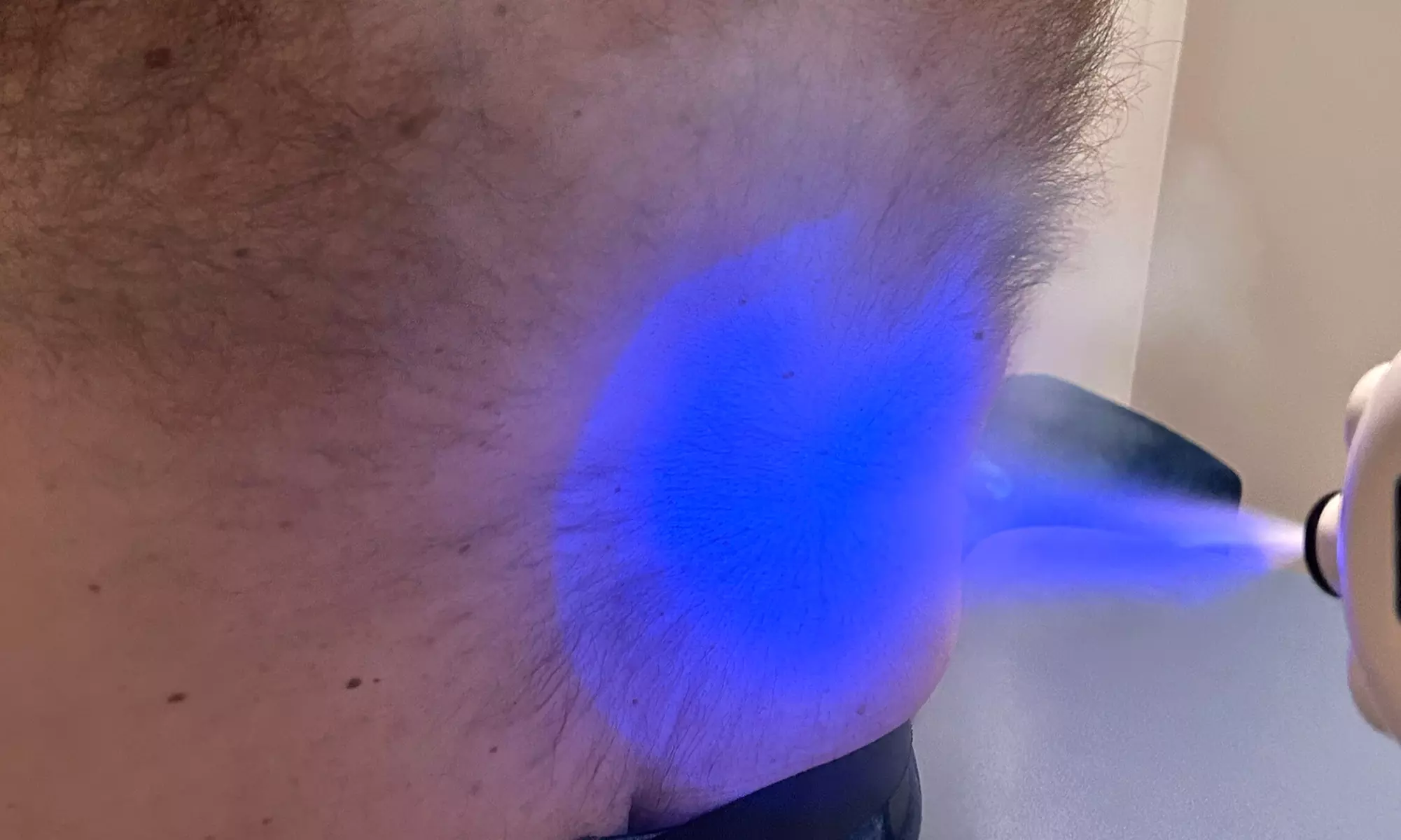 Targeted Cryotherapy Relief: Opt for Single or Multiple Sessions