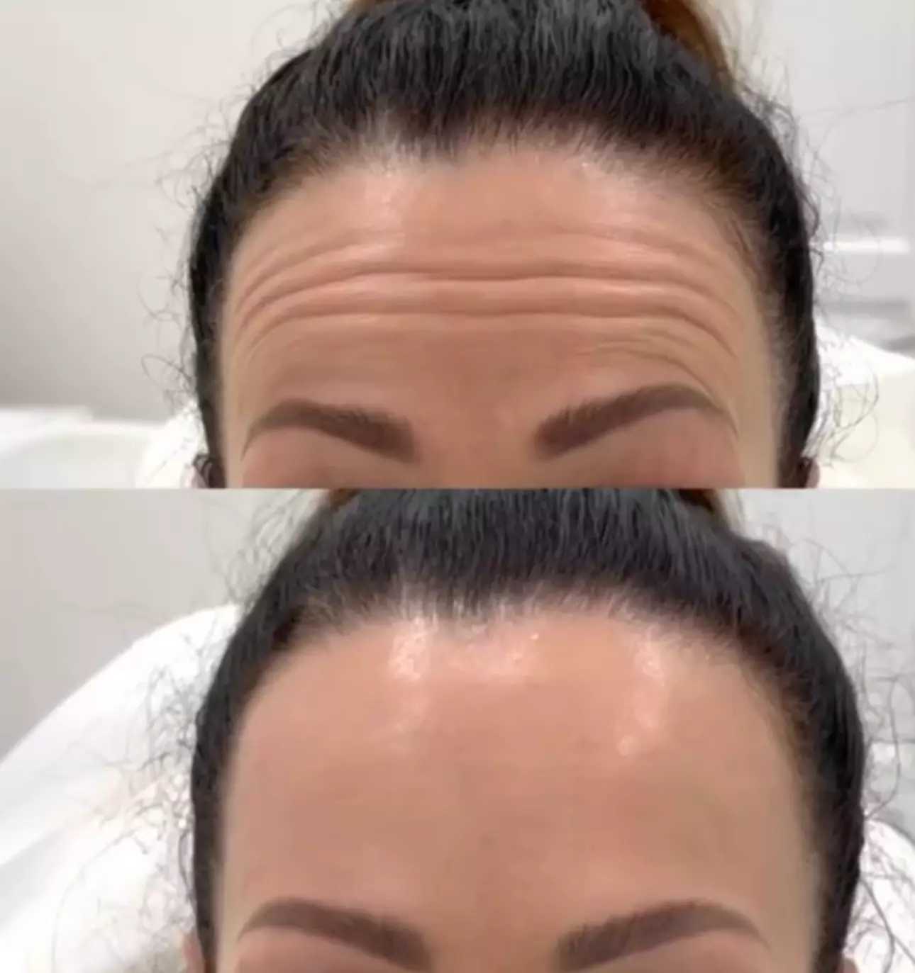 Enhance Your Skin with 20, 40 or 60 Units of Botox