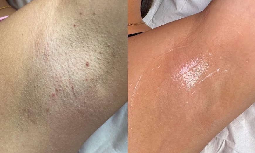 Image 2: Three or Six Laser Hair Removal Sessions for S, M, L Areas / Full Body