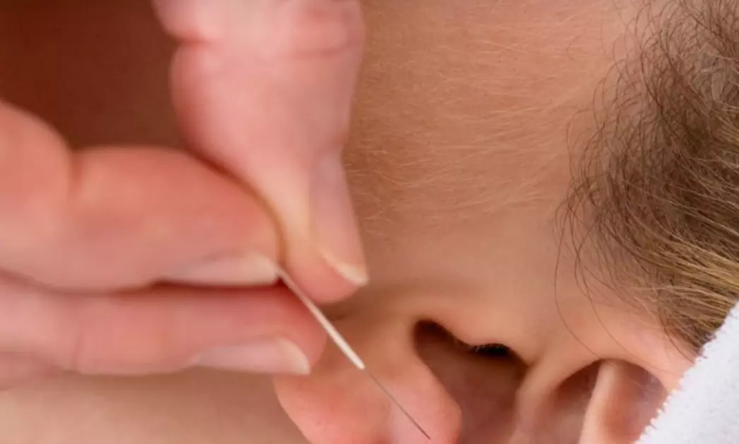 Revitalize with Body cupping, Full Face/3 Session Cosmetic Acupuncture