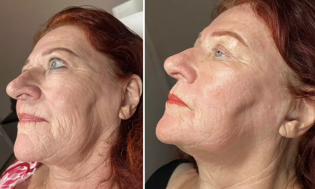 CO2 Laser Skin Resurfacing – Smooth, Tighten & Renew